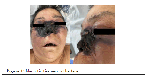 bacteriology-parasitology-Necrotic-tissues