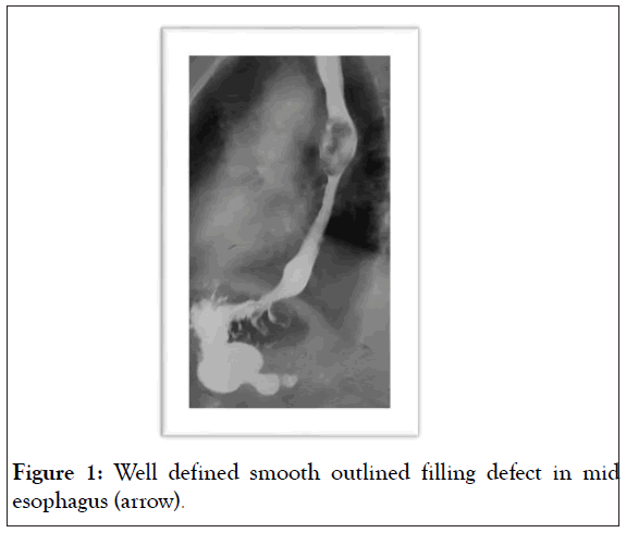 esophagus