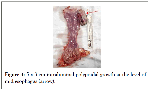 intraluminal