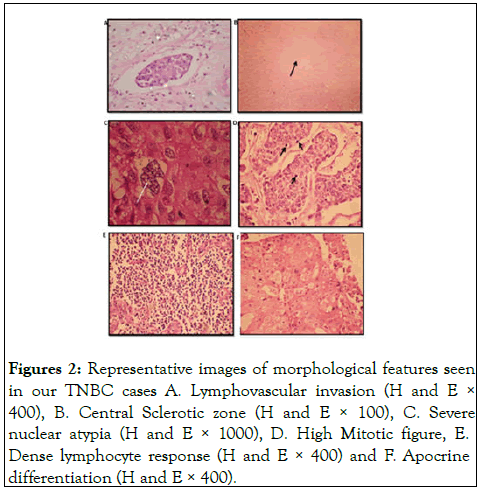 gene-technology-tnbc