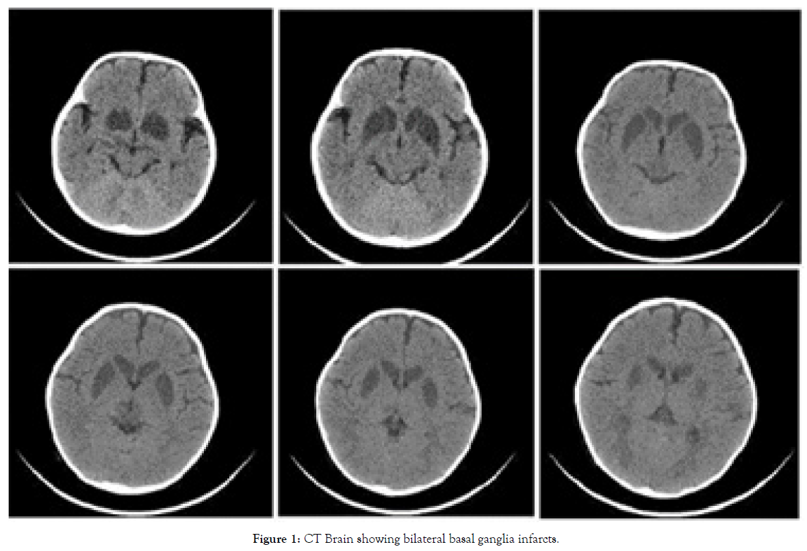 nutritional-disorders-therapy-bilateral-basal