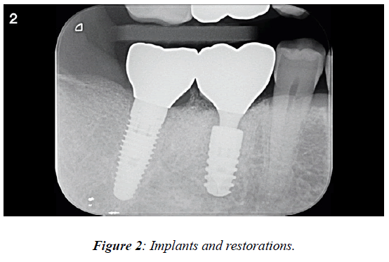 Implants