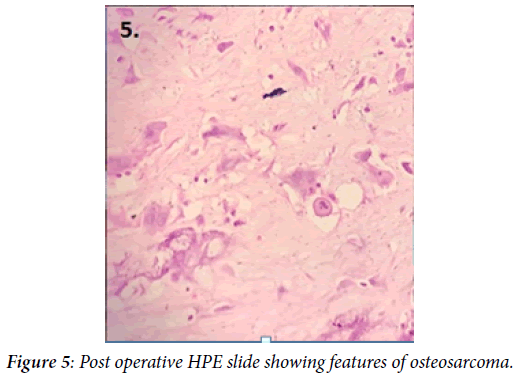 osteosarcoma