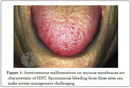 surgery-anesthesia-arteriovenous