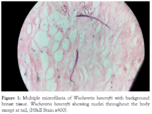 tropical-diseases-microfilaria