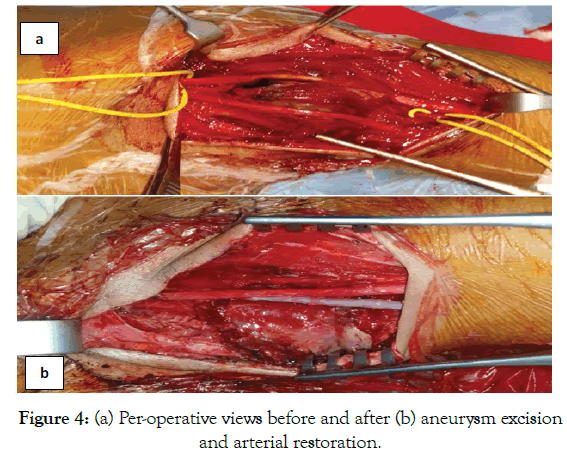vascular-medicine-aneurysm