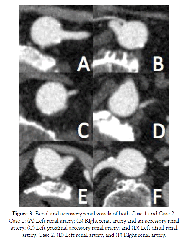 vascular-medicine-renal