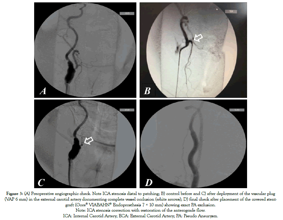 vascular-medicine-stenosis