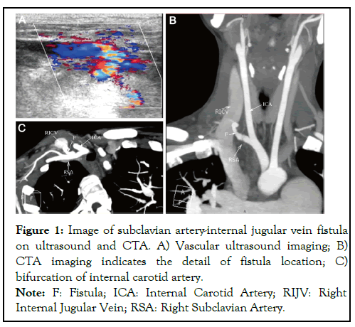 vascular-medicine-subclavian