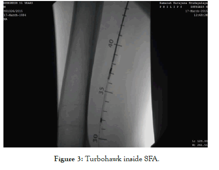 vascular-medicine-surgery-Turbohawk