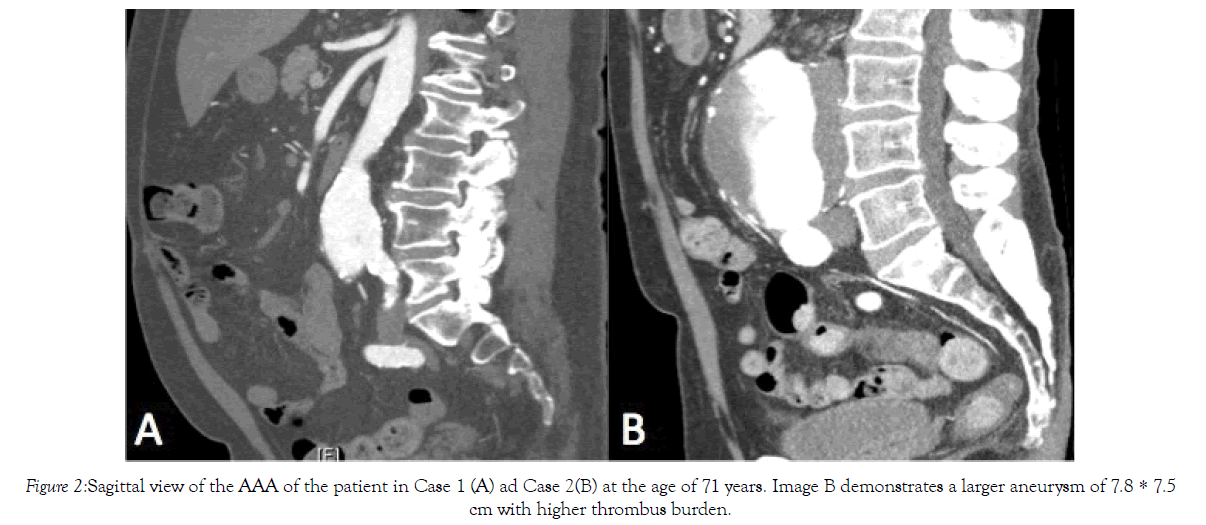 vascular-medicine-thrombus