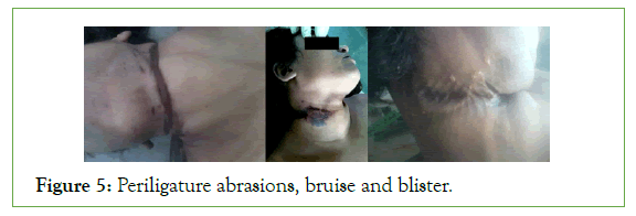 forensic-abrasions