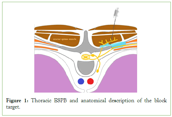 pain-management-Thoracic