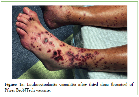 vascular-medicine-vasculitis