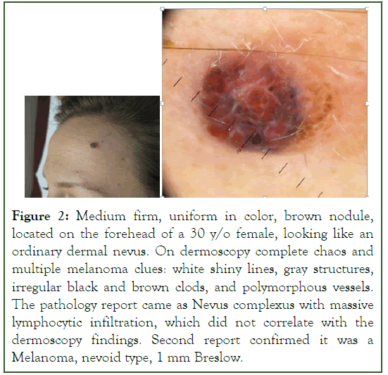 Carcinogenesis-Medium