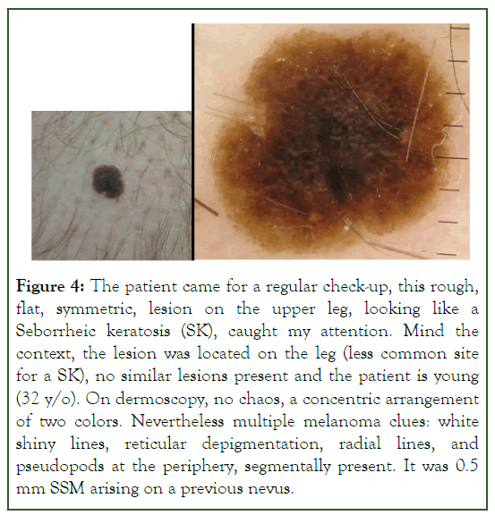 Carcinogenesis-lesion