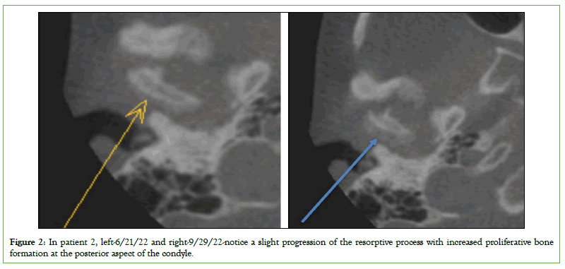 proliferative