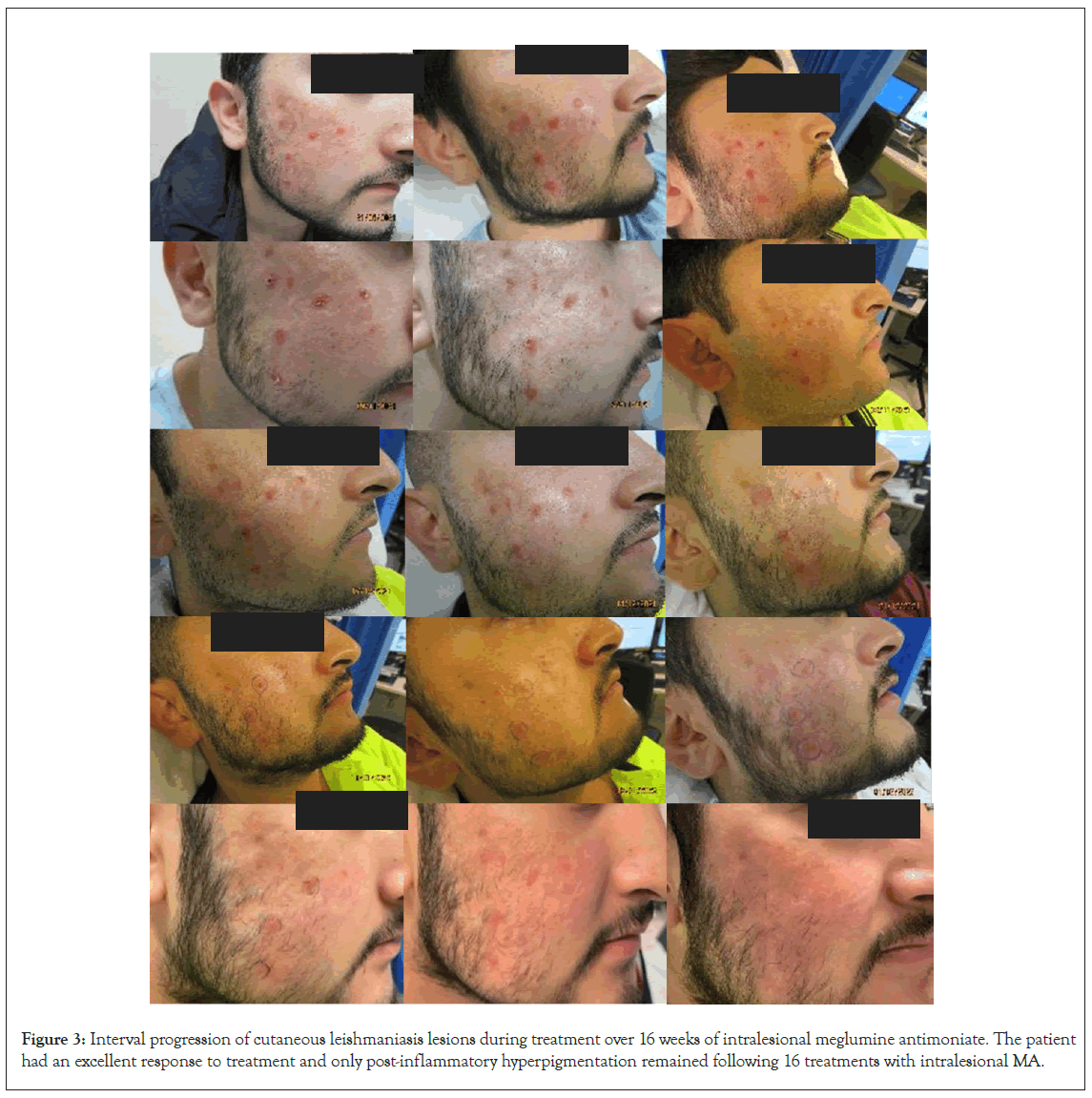 Dermatitis-cutaneous