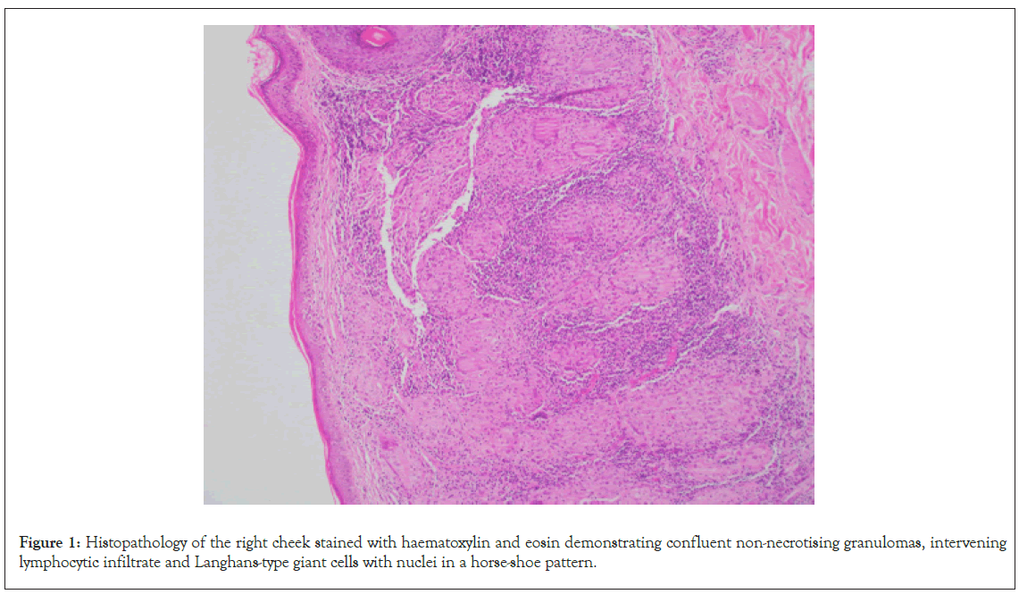 Dermatitis-haematoxylin