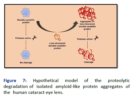 Eye-Cataract-Hypothetical