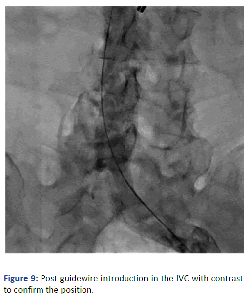 Imaging-Radiology-guidewire