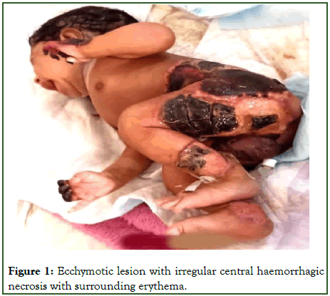 Journal-Dermatitis-Ecchymotic