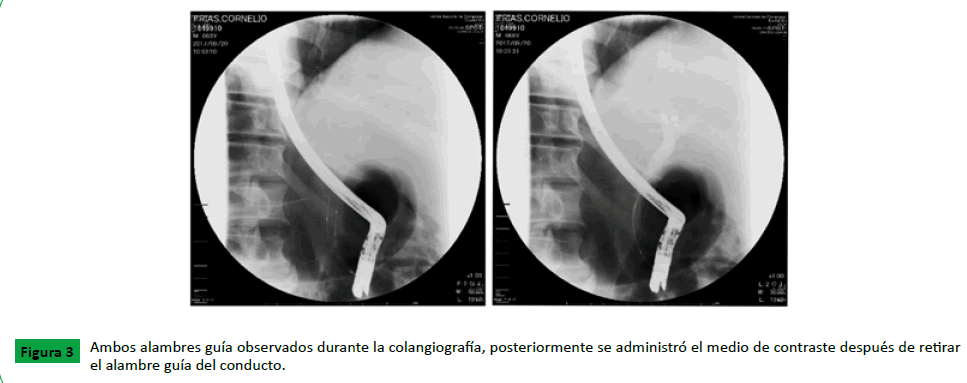 Medicina-herramienta-colangiografía