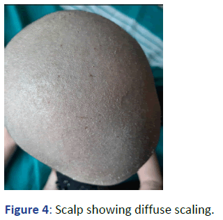 Pediatric-Dermatology-Scalp