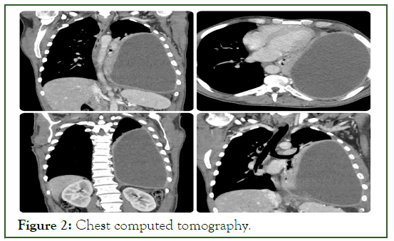 Surgery-Chest