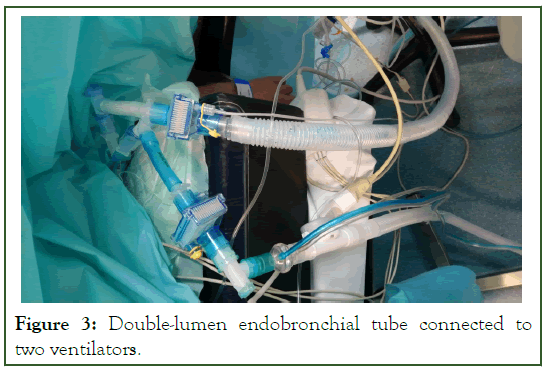 Surgery-endobronchial