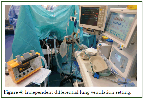 Surgery-lung