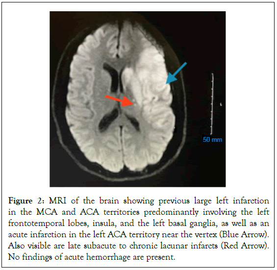 Thrombosis-Circulation-Arrow