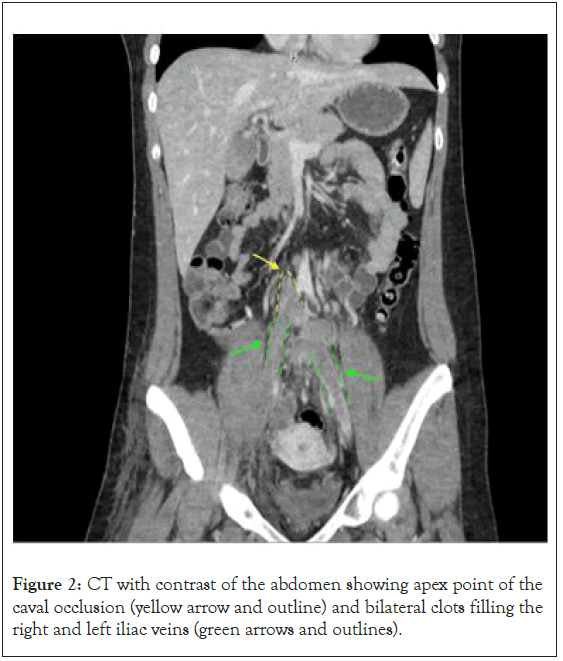 Thrombosis-Circulation-abdomen