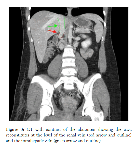 Thrombosis-Circulation-cava