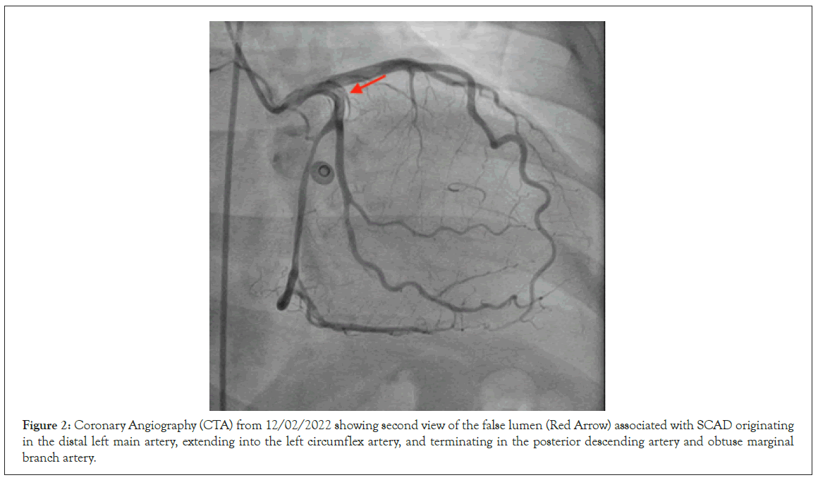 Thrombosis-Circulation-distal