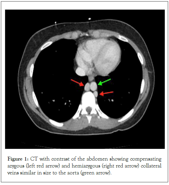 Thrombosis-Circulation-hemiazygous