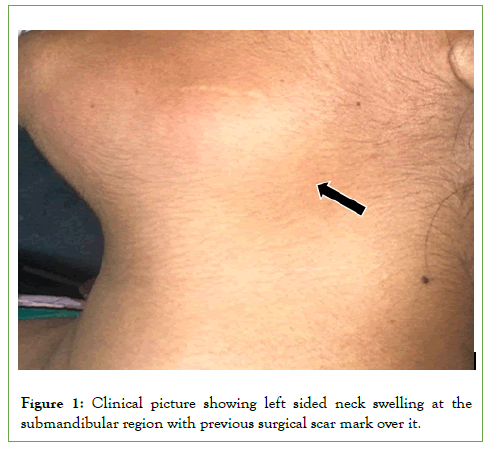 Vascular-Medicine-AngioJet