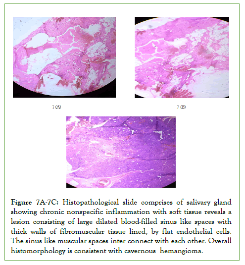 Vascular-Medicine-hemangioma