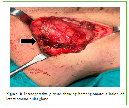 Vascular-Medicine-hemangiomatous