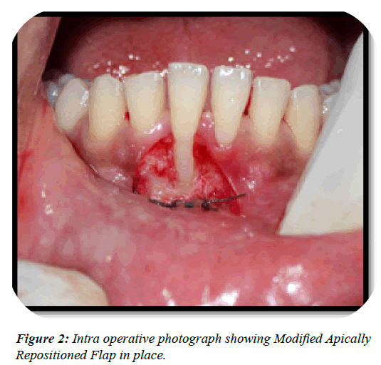 dental-management-Apically