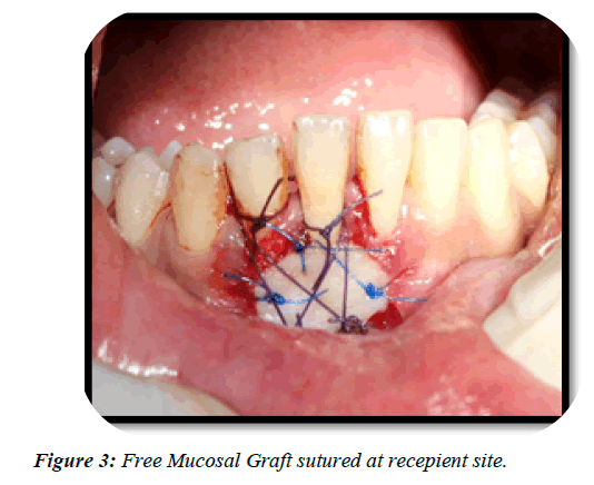 dental-management-Graft