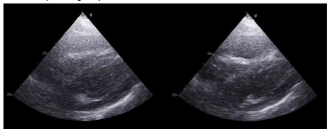 intensive-pericardial