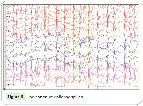 journal-neurology-spikes