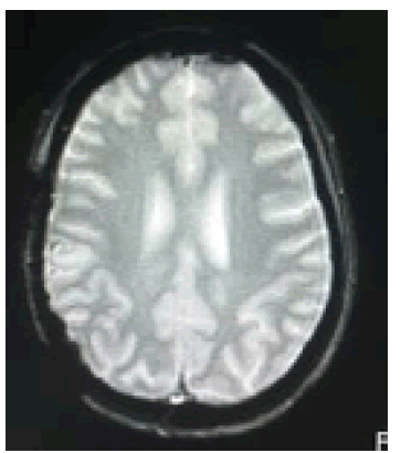 neuro-hematoma