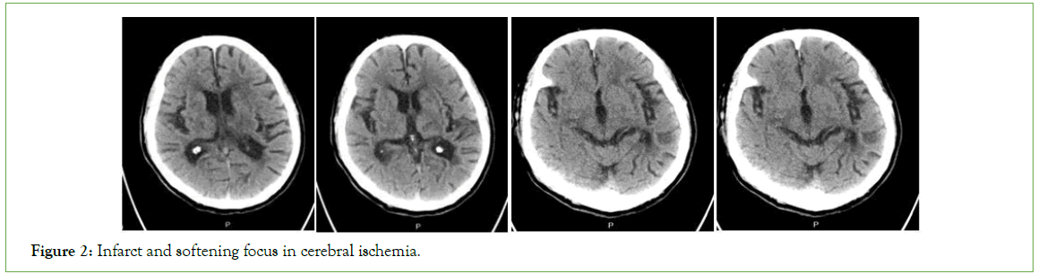 psychiatry-Infarct