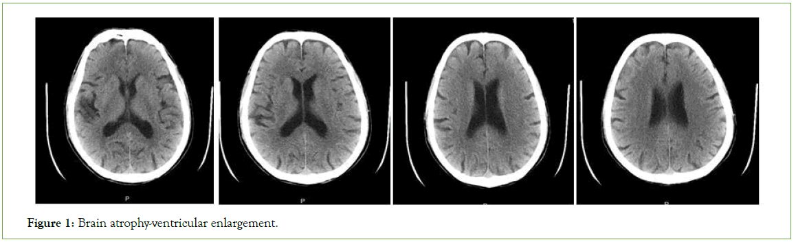 psychiatry-atrophy