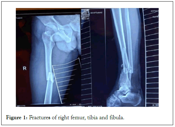 surgery-anesthesia-Fractures