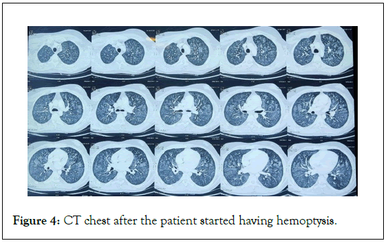 surgery-anesthesia-hemoptysis