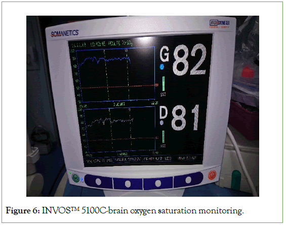 surgery-anesthesia-monitoring