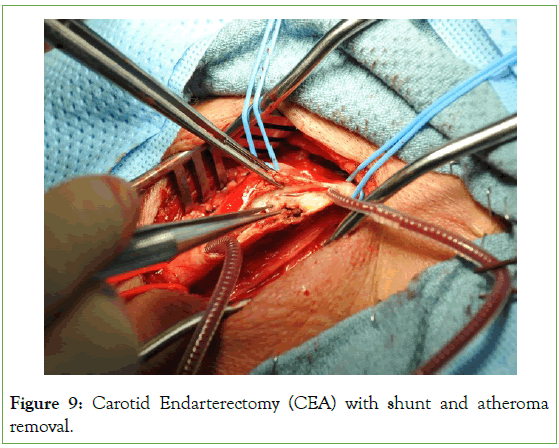 surgery-anesthesia-removal